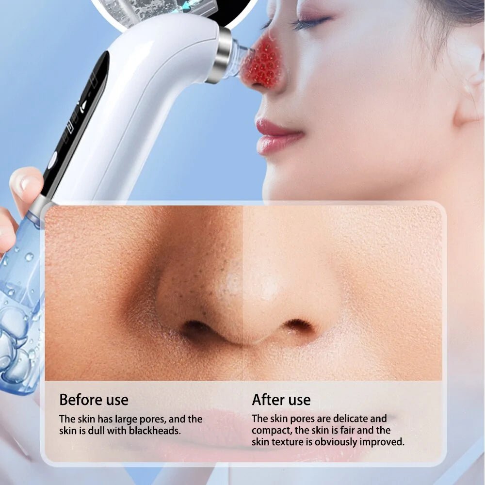 Blackhead Remover Device - 