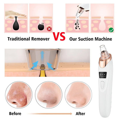 Blackhead Remover Vacuum Acne Pimple Black Spot - Organic Beauty Solution