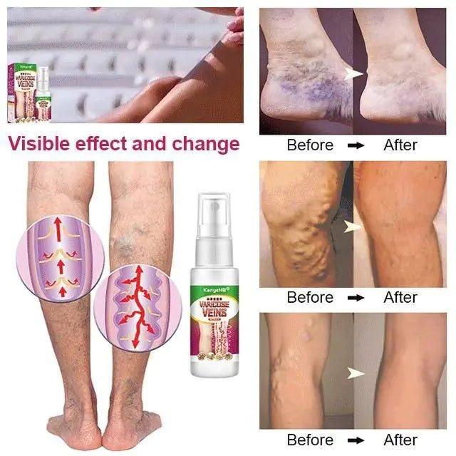 Varicose Veins Treatment Spray - Organic Beauty Solution