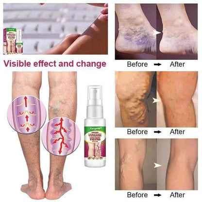 Varicose Veins Treatment Spray - Organic Beauty Solution