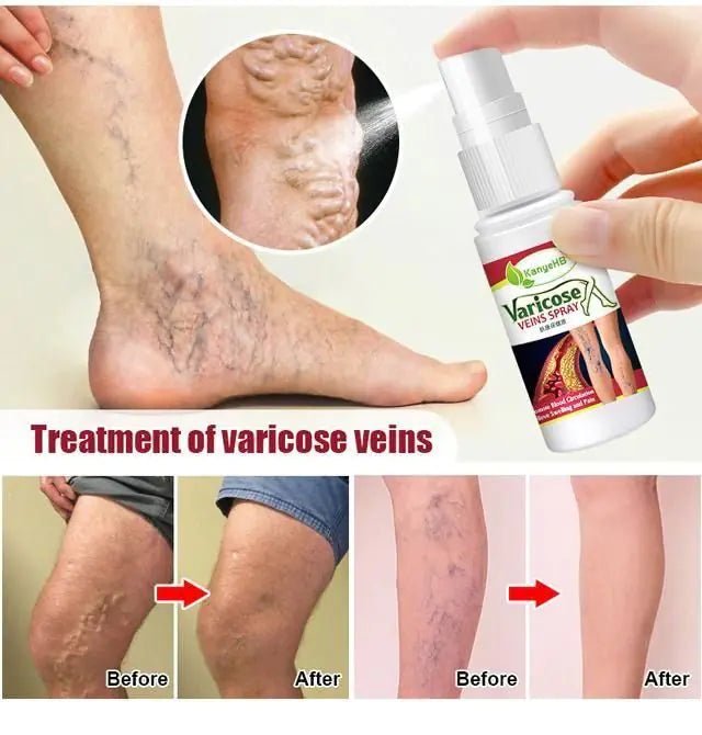 Varicose Veins Treatment Spray - Organic Beauty Solution